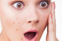 √ 13 Cara Menghilangkan Bekas Jerawat Paling Ampuh (Alami dan Efektif)