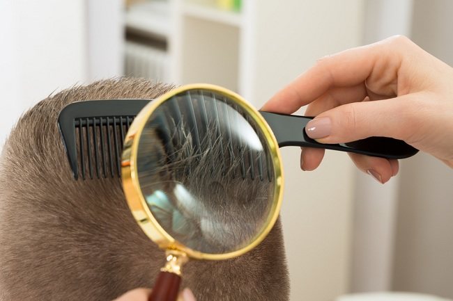 √ 11 Cara Menghilangkan Kutu Rambut | Cara Penularan dan Pencegahannya