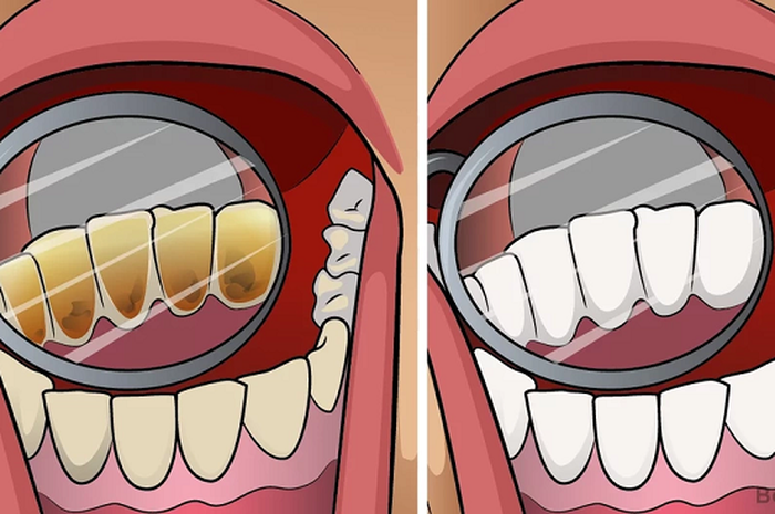 √ 9 Cara Menghilangkan Karang Gigi (Sederhana dan Efektif)